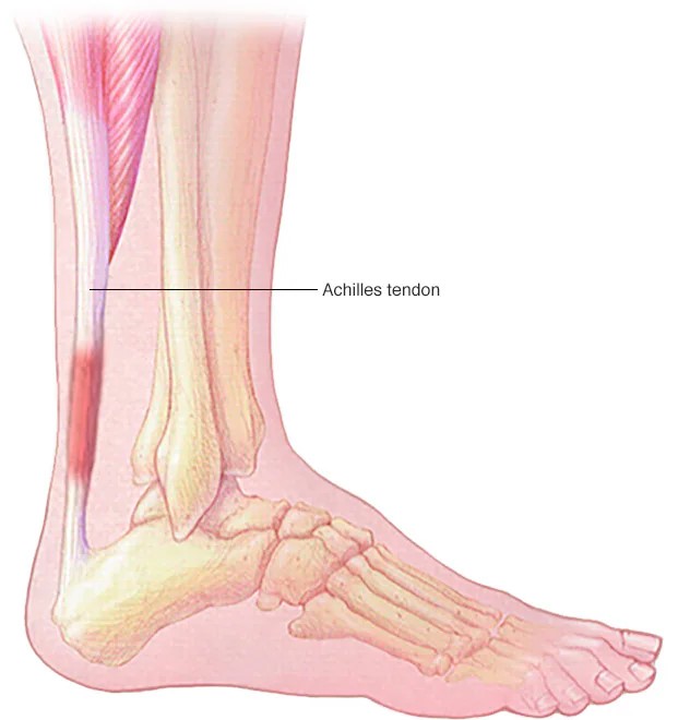 achilles-tendinitis