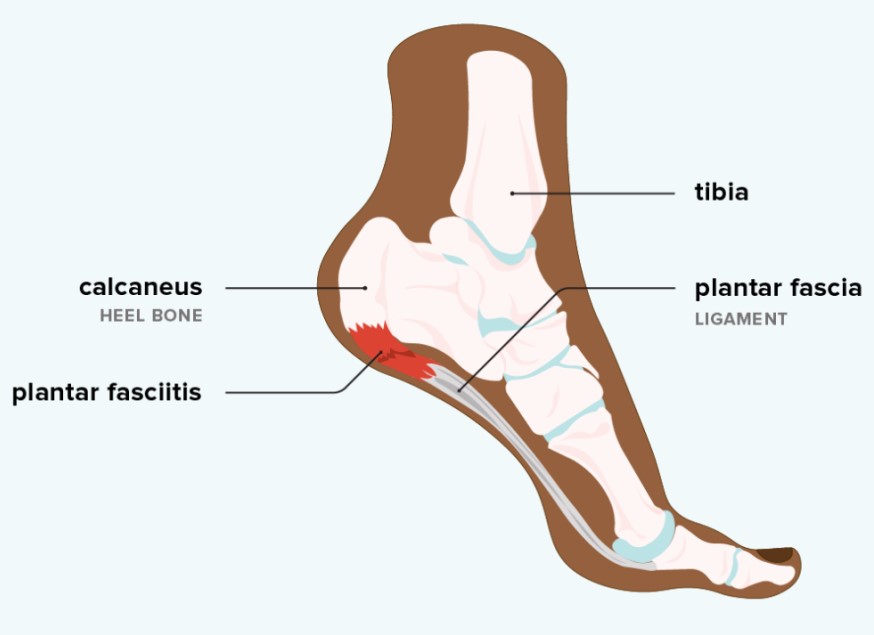 plantar-fasciitis-1296×1000-body-1-1296×1004